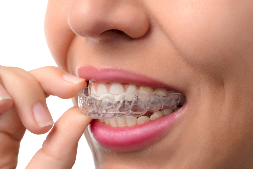 How Do Invisalign Braces Work? Fitting, Benefits & Aftercare