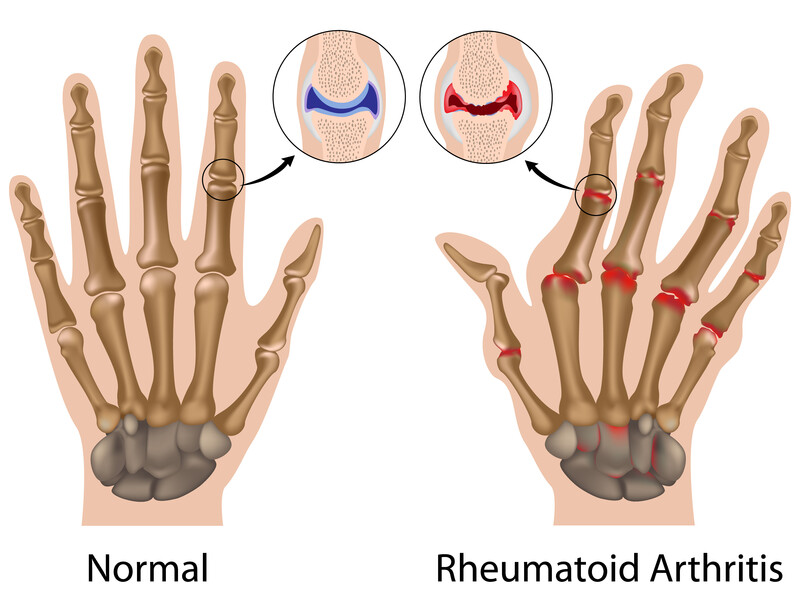 finger arthritis